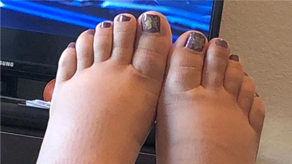 విపరీతమైన కాళ్ళ వాపులా?