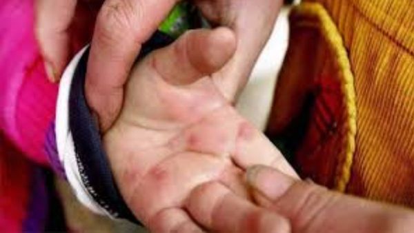 టమోటా వైరస్ కలకలం.. 12 ఏళ్ల లోపు చిన్నారులు బీ కేర్ ఫుల్ !