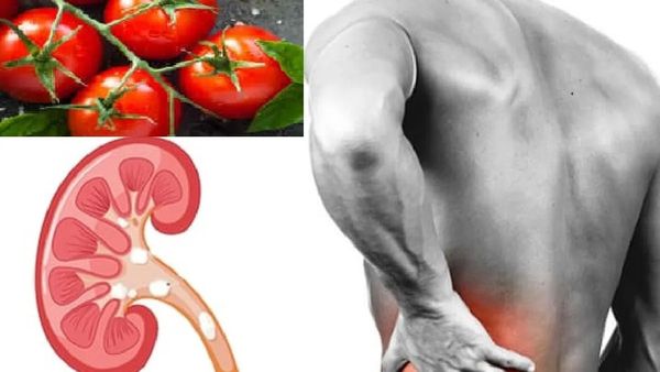 టమోటాలు తింటే కిడ్నీలో రాళ్లు వస్తాయా...? వీరు దూరంగా ఉండాలి..!!