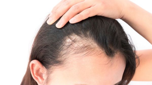 బట్టతల వచ్చిందని విడాకులు.. ఏంటండీ ఈ ఘోరం !