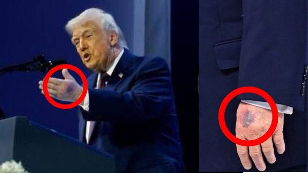 Donald Trump: గాయాలపాలైన ట్రంప్, ఆరోగ్యంపై ఆందోళన