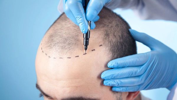 టర్కీని వెనక్కి నెట్టిన భారత్.. హెయిర్ ట్రాన్స్‌ప్లాంట్‌లో నెం.1 !!