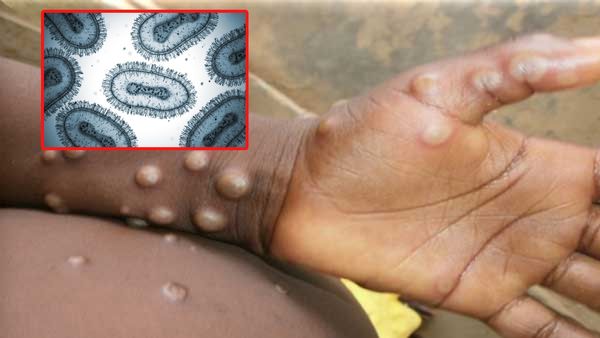 భారత్‌లో కొత్త రకం మంకీపాక్స్ కలకలం.. WHO హెచ్చరికలతో అలర్ట్!