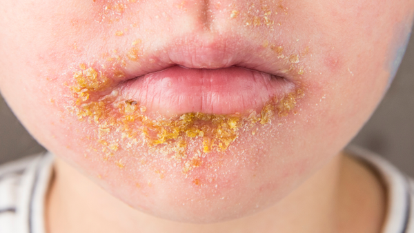 ‘నా ఒంటిపై దద్దుర్లు వచ్చాయి, ఇది మంకీపాక్సేనా’