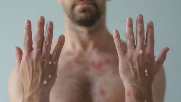 మంకీపాక్స్: 'జననేంద్రియాలపై కురుపులు... దుస్తులు ధరిస్తే తట్టుకోలేనంత మంట'
