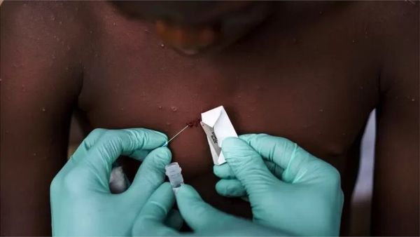 మంకీపాక్స్: 75 దేశాలు, 16 వేల కేసులు...గ్లోబల్ హెల్త్ ఎమర్జెన్సీ ప్రకటించిన ప్రపంచ ఆరోగ్య సంస్థ