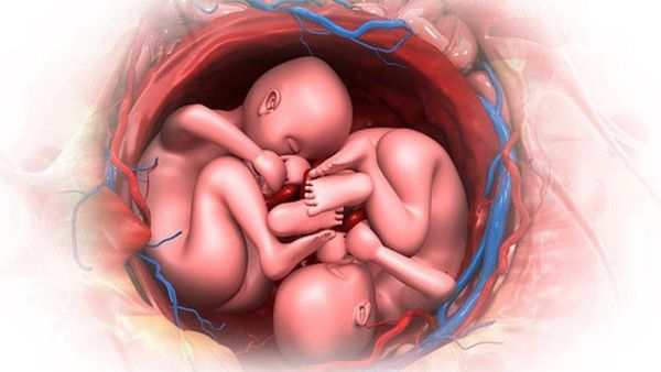 కవల పిండాల్లో ఒకదాన్ని తొలగించాలని కోర్టుకెక్కిన మహిళ...చట్టం ఒప్పుకుంటుందా?