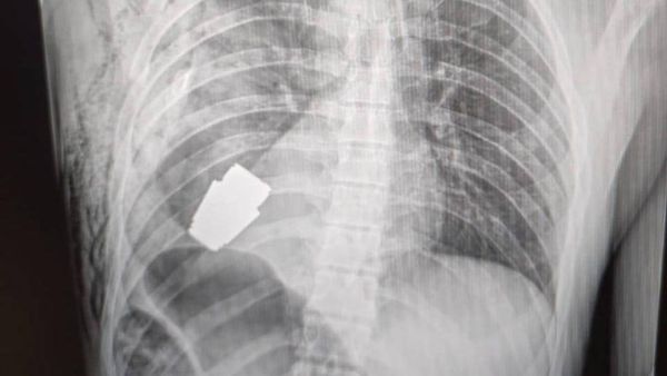 హ్యాపీ షాక్: జవాన్ గుండెలో ఇరుక్కున్న పేలని గ్రెనెడ్, డాక్టర్లు, బాంబ్ స్క్వాడ్‌ను రప్పించాక....