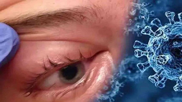 Mucormycosis Mucormycosis