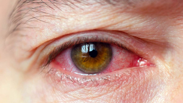 conjunctivitis