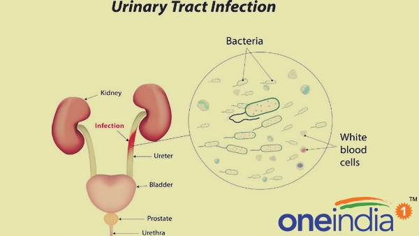 Causes of UTI Infection Causes of UTI Infection