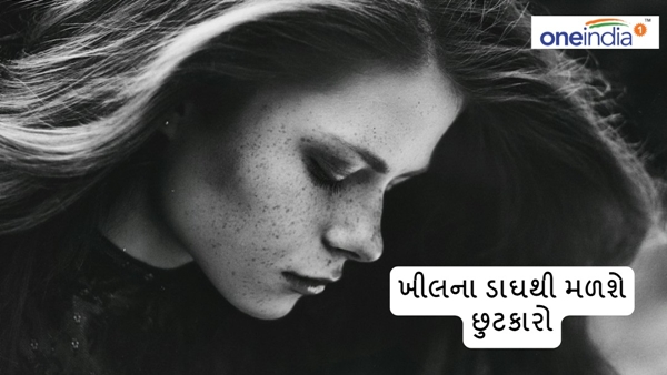 How to get rid From Pimple