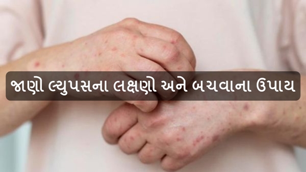 what is lupus in Gujarati