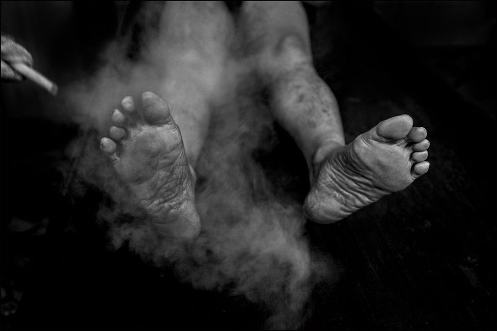 ભોપાલની સંભાવના ટ્રસ્ટ ક્લિનિકમાં એક પીડિતની સ્ટીમ થૅરપીથી સારવાર થઈ રહી છે. આ ક્લિનિકમાં પારંપરિક આયુર્વેદિક દવાથી પીડિતોનો ઇલાજ થાય છે.