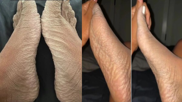 16 घंटे तक नहाने के बाद महिला को हुई अजीब बीमारी, सलाह मांगने पर हर कोई पूछ रहा एक ही सवाल