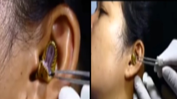 VIDEO: 'लगता है उसे दिशाभ्रम हो गया', महिला के कान में घुसा छोटा सांप, डॉक्टर ने उठा लिया चिमटा