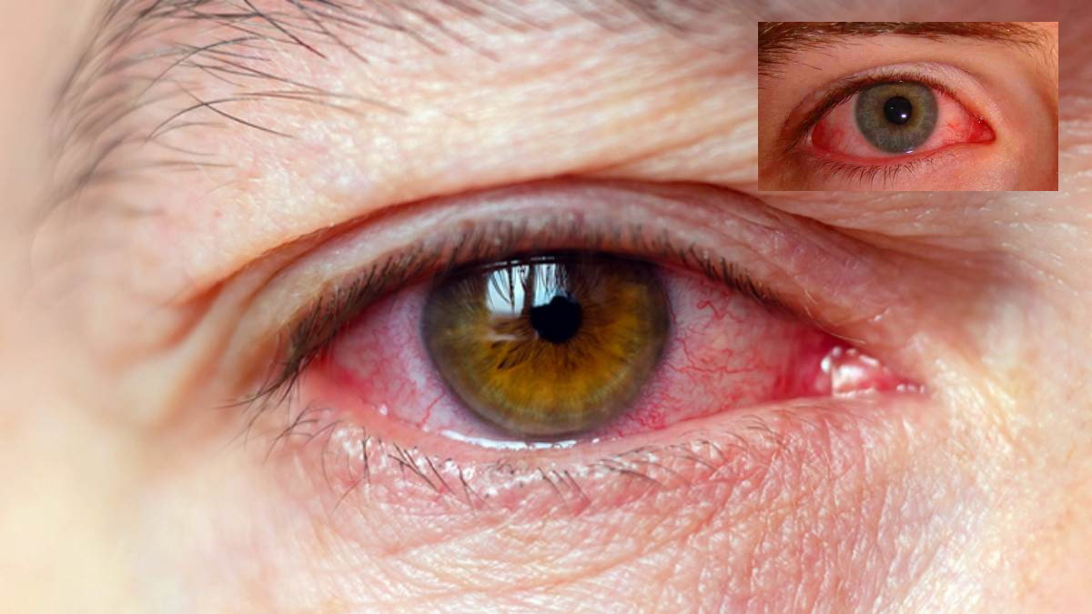 Eye Flu: बरसात के मौसम में तेजी से फैल रहा है Conjunctivitis, जानें कारण और कैसे रखें आंखों का ख्‍याल