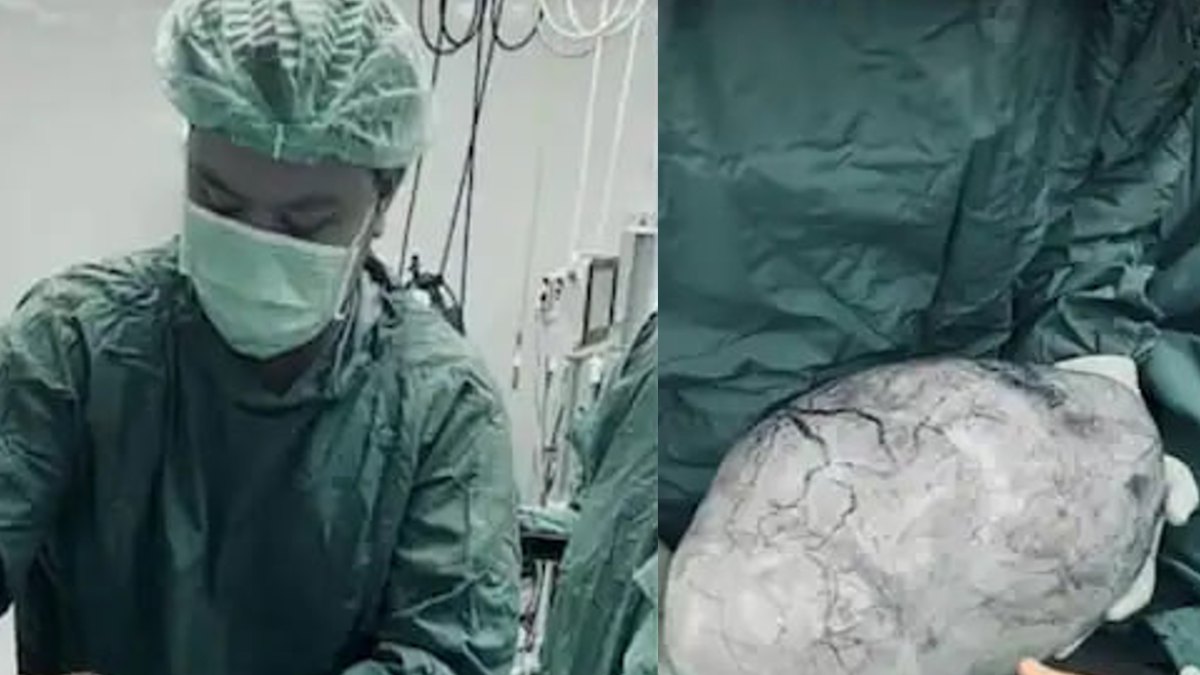 Ovarian Cyst: मोटापे से जूझ रही थी महिला, डॉक्टर के पास गई तो उड़े होश, शरीर में था 9 किलो का सिस्ट
