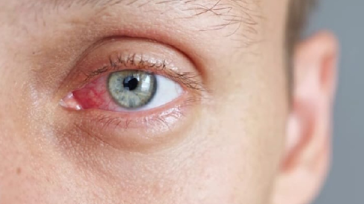 MP news: Eye Flu के इलाज में आयुर्वेद निभा रहा अहम भूमिका, क्या है आसान इलाज, जानिए?