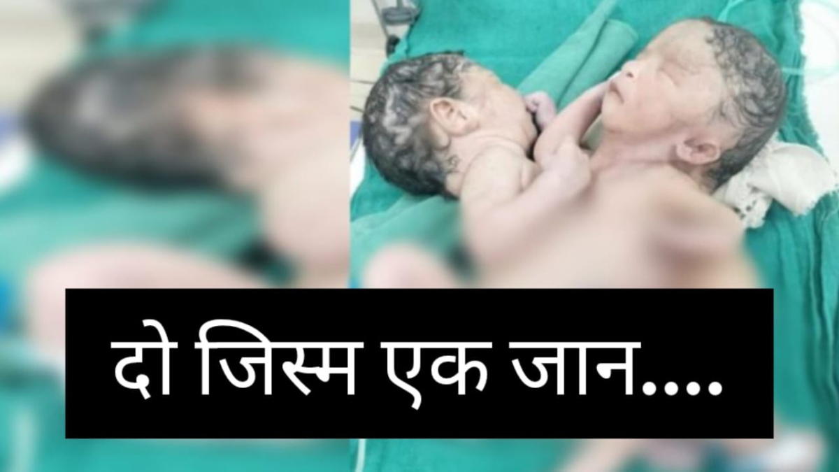 ये तो अद्भुत है! दो जिस्मों में धड़क रहा एक दिल, अनोखे जुड़वां बच्चें के जन्म से डॉक्टर हैरान, परिवार चिंतित