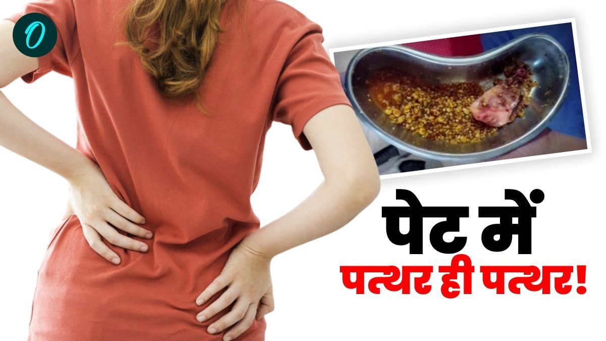 पथरी का दुर्लभ मामला! डॉक्टरों ने महिला के गॉलब्लेडर से निकाली 1235 पथरी, आयुष्मान कार्ड से हुआ मुफ्त इलाज