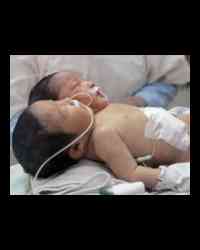 2 headed infant