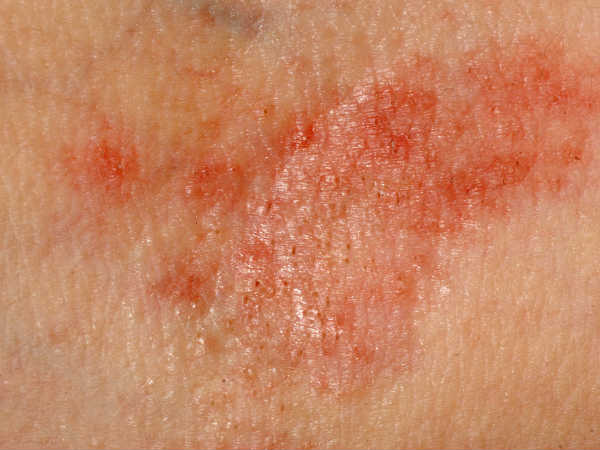 कैडमियम के कारण त्वचा रोग