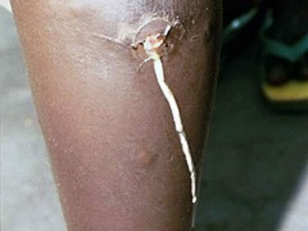 Parasitic Roundworm Diseases जब निकलता है Parasitic Roundworm Diseases जब निकलता है