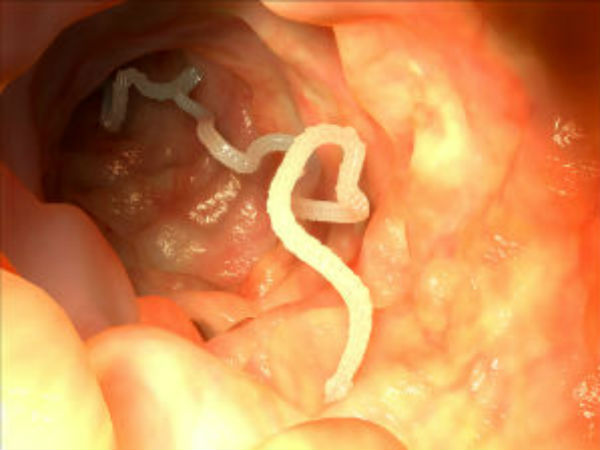 Parasitic Roundworm Diseases शरीर के अंदर Parasitic Roundworm Diseases शरीर के अंदर