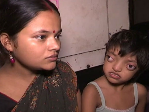 crouzon syndrome disease in hindi crouzon syndrome disease in hindi