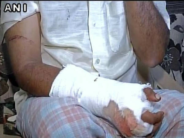 ईमानदारी की मिली सज़ा, ठेकेदारों ने कुल्हाड़ी से काट दिया अधिकारी का हाथ