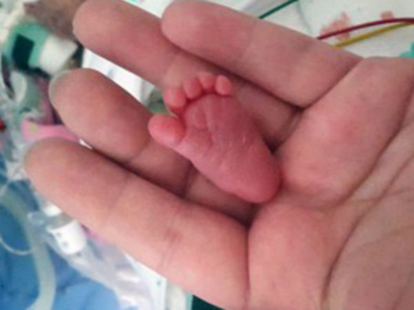 World’s ‘tiniest baby World’s ‘tiniest baby