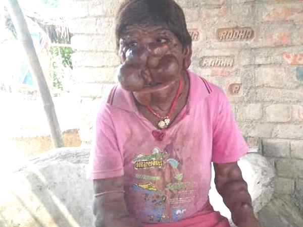 छोटी सी फुंसी से हुआ ऐसा हाल 