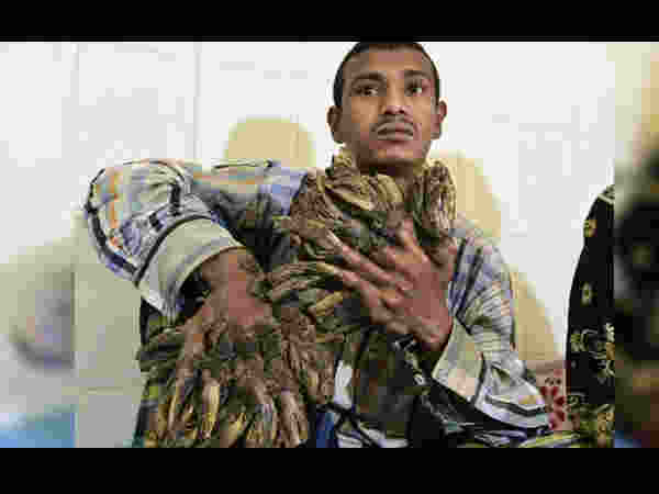 Bangladesh 'Tree Man' Sees Hope After 16 Surgeries Bangladesh 'Tree Man' Sees Hope After 16 Surgeries