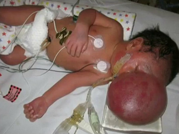 Baby boy born with brain on the outside of his skull has marathon six-hour surgery to save his life Baby boy born with brain on the outside of his skull has marathon six-hour surgery to save his life