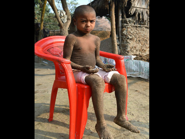 OMG Boy turn into stone day by day OMG Boy turn into stone day by day