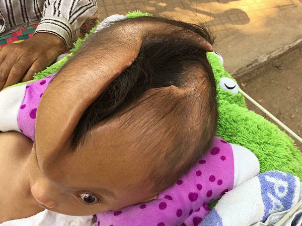 baby boy with 4 inch deep crack in his entire skull, need help baby boy with 4 inch deep crack in his entire skull, need help