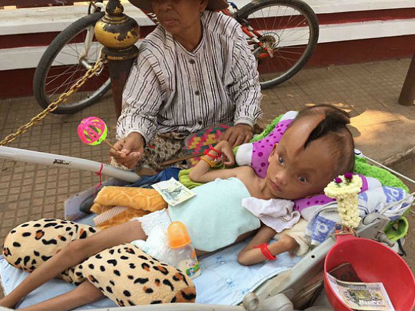 baby boy with 4 inch deep crack in his entire skull, need help baby boy with 4 inch deep crack in his entire skull, need help