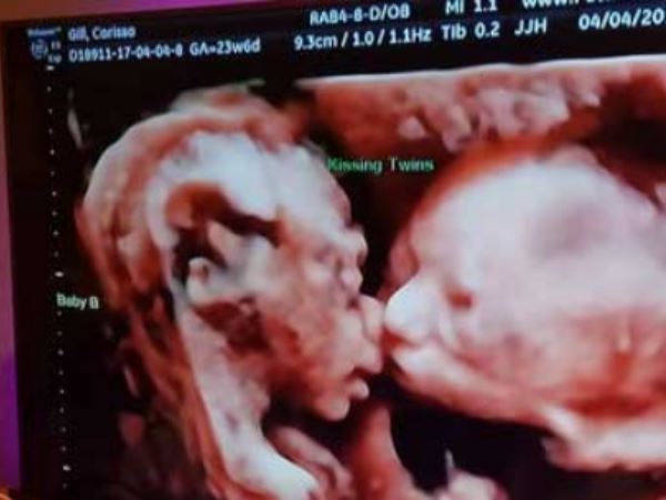 अल्ट्रासाउंड में दिखा गर्भ में प्यार करती जुड़वा बहनों का प्यार, दिल जीत लेगी तस्वीर अल्ट्रासाउंड में दिखा गर्भ में प्यार करती जुड़वा बहनों का प्यार, दिल जीत लेगी तस्वीर