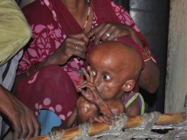 क्या है यह प्रोजेरिया बीमारी 