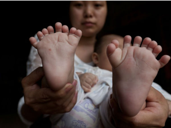  Chinese boy born with 31 fingers and toes