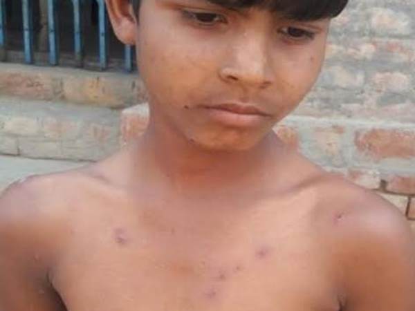 बहराइच:गांवों में खसरा फैला, 22 बच्चे बीमार, 6 की हालत नाजुक