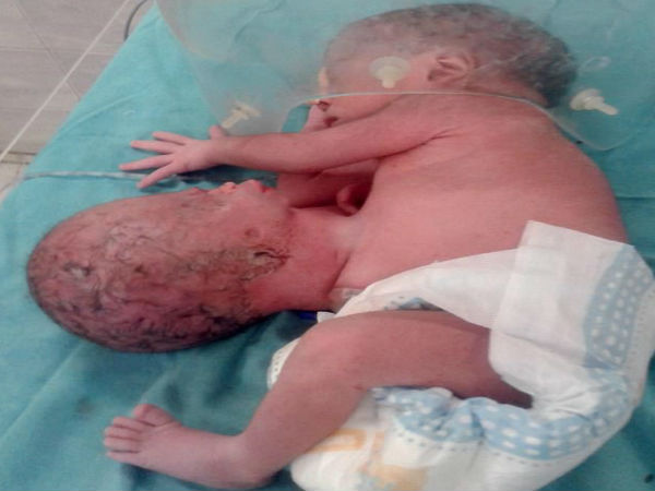 दुर्लभ बीमारी 