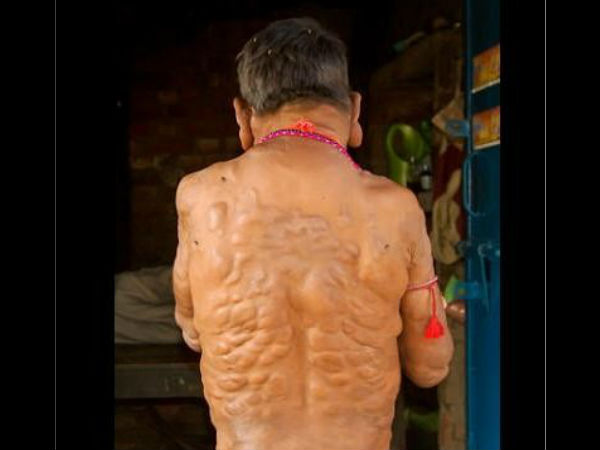  जैनेटिक बीमारी 