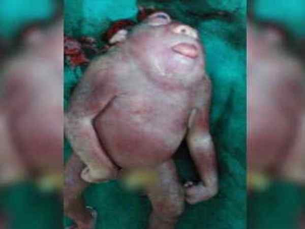 बच्चे के शरीर में गर्दन ही नहीं थी