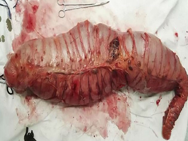  कब्ज से परेशान था युवक