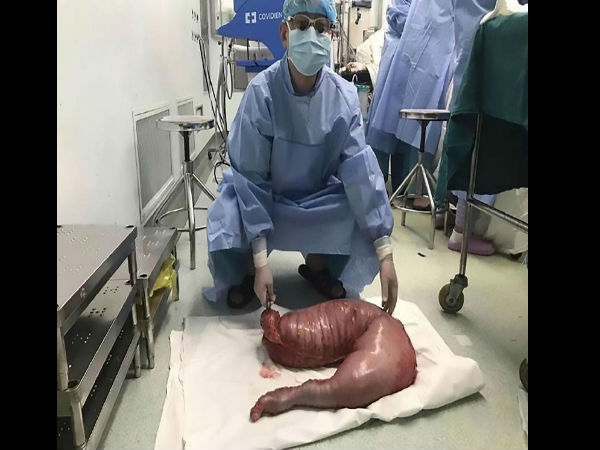  पेट में थी 13 किलो की गांठ