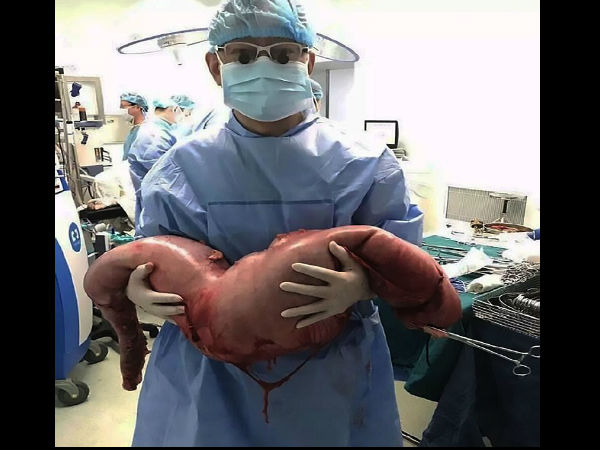  9 महीने की प्रेग्‍नेंट महिला की तरह था पेट