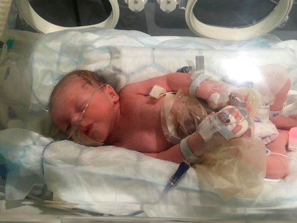  फटे पेट के साथ पैदा हुए बच्चे