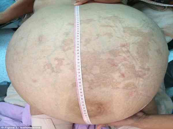 गर्भाशय से निकला ट्यूमर गर्भाशय से निकला ट्यूमर